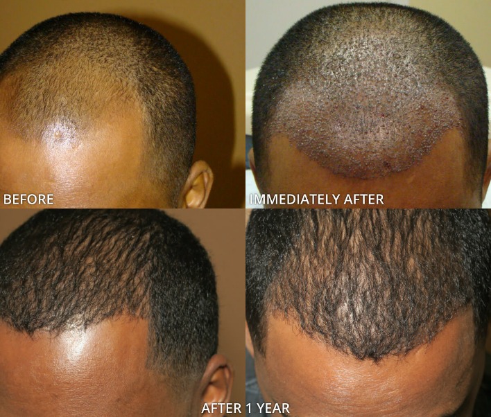 How Much Do Hair Transplants Cost? Hair Transplant Cost Guide